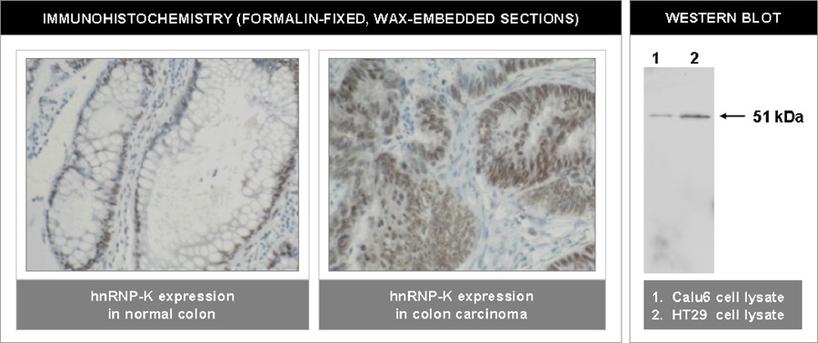 "Left and Center: Immunohistochemical staining of normal colon (left) and colon carninoma (center) using hnRNP-K antibody (Cat. No. X2068M).
Right: Western blot using hnRNP-K antibody on Calu6 (1) and HT29 (2) cell lysates."
